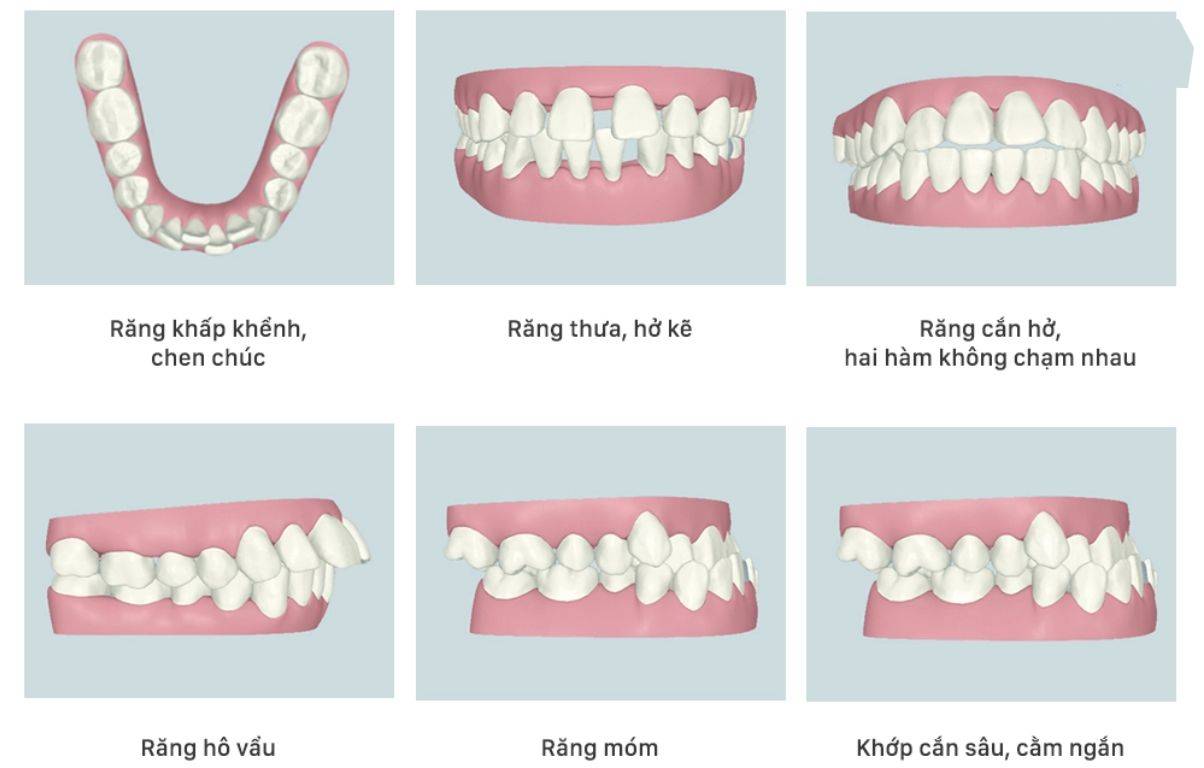 Niềng răng trong suốt cho trẻ phù hợp với nhiều tình trạng răng khác nhau